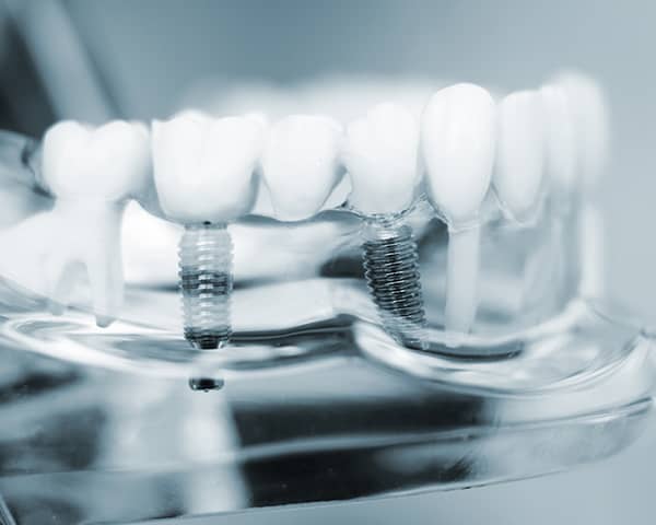 Dental Implants Periodontist in Norristown, PA - Carp Dental